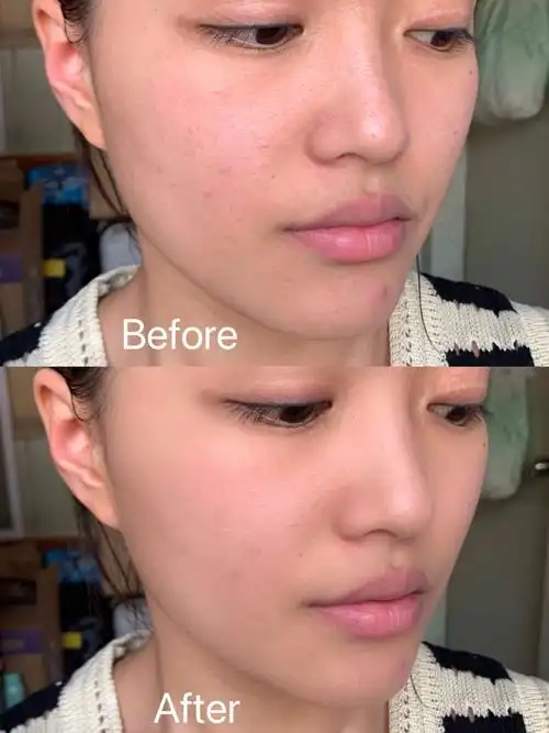 毛孔更明显了而且只要一出点油妆容就斑驳鼻翼周围还有小芝麻粒那你