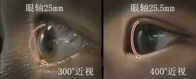 5毫米,眼眶空间不足,所以300度近视比400度近视眼球