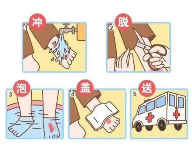 温度连升,烧伤烫伤事故多发,你该知道这样处理!