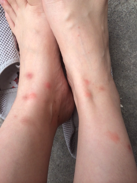 [母乳喂养]用电熨斗烫还是不能去除螨虫 咬的越来越严重