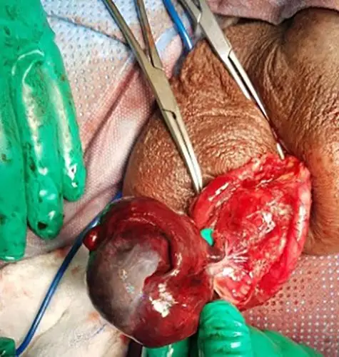 老年人急性阴囊疼痛诊断为何罕见病例