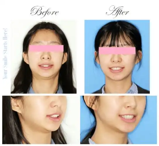 矫正前后面像对比