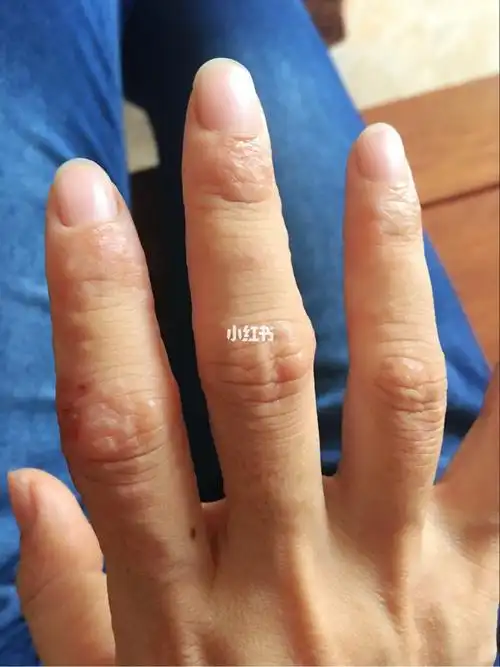 两只手都长满汗疱疹简直是折磨人啊要怎样才能治愈太难了这道题我不会