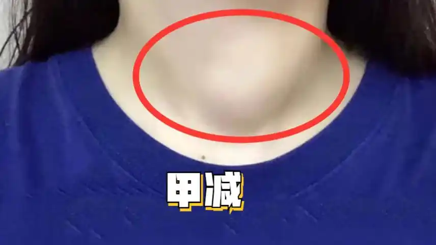 警惕甲减药物副作用!康复者揭秘自用妙招,搞定粗脖更安全!