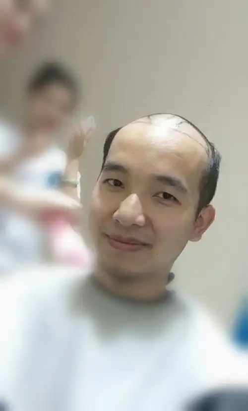 秃头油腻大叔,现植发归来帅回原来样子!