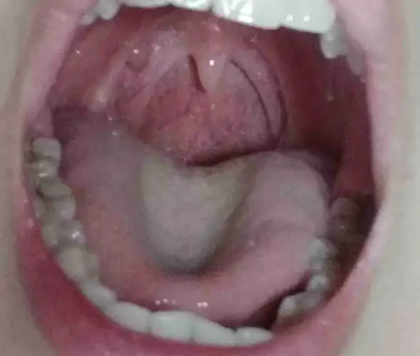 最近有点上火,嗓子干,看见左上鄂好像有个小疙瘩,咽喉正常么