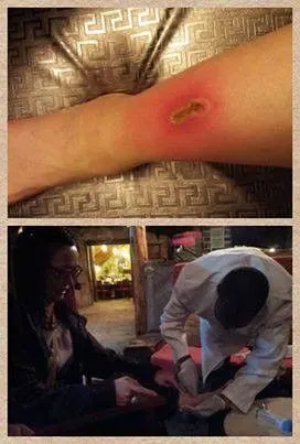 徐薇请非洲医师治疗伤口,疑似因刀片未消毒引发蜂窝性组织炎.