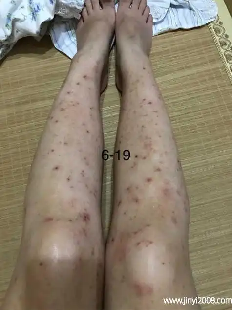 蚊子咬起水泡多久能好蚊子咬后留下黑疤怎么去除