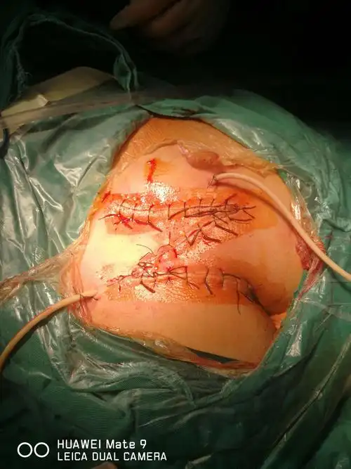 复发性骶尾部藏毛窦z型皮瓣成形术 胃肠胸外科 梁万明