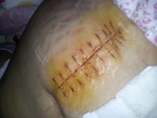 刨腹产的晾一下刀口看看吧.