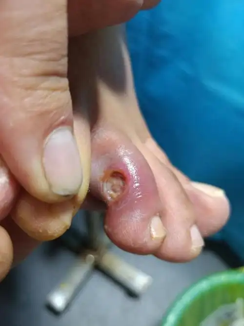 张店区中医院内分泌科糖尿病足病例 :小溃疡 大学问 咨询电话