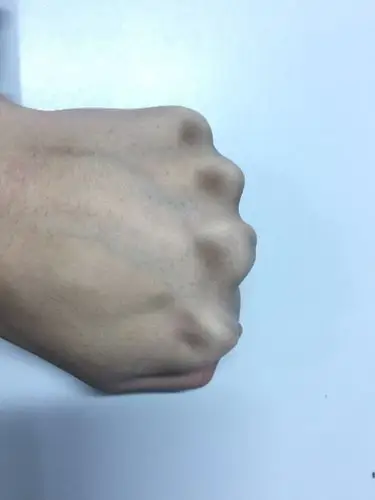 手背的骨头上长了一些黑色的东西,不通不痒,表面有些粗糙干燥,请问