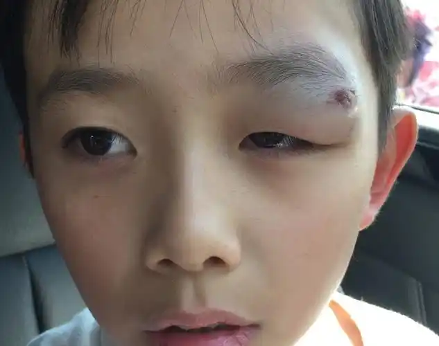 眼睛撞到要怎麼办?