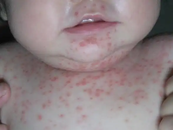 孩子牛皮癣饮食注意事项_护理_护理治疗_牛皮癣银屑病_慢性病健康网