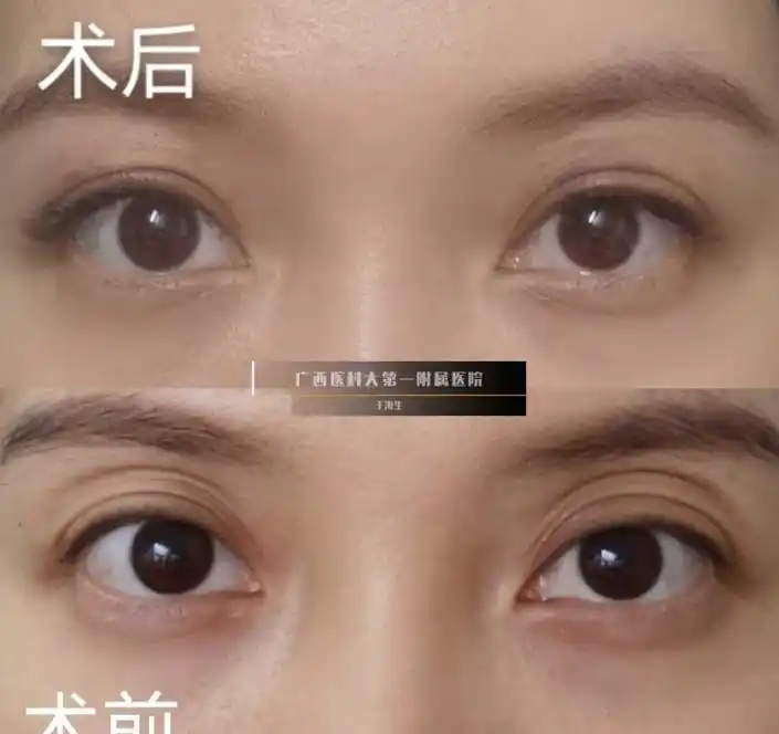 什么原因会引起眼窝凹陷,该如何填充?怎么减少眼窝凹陷的发生?