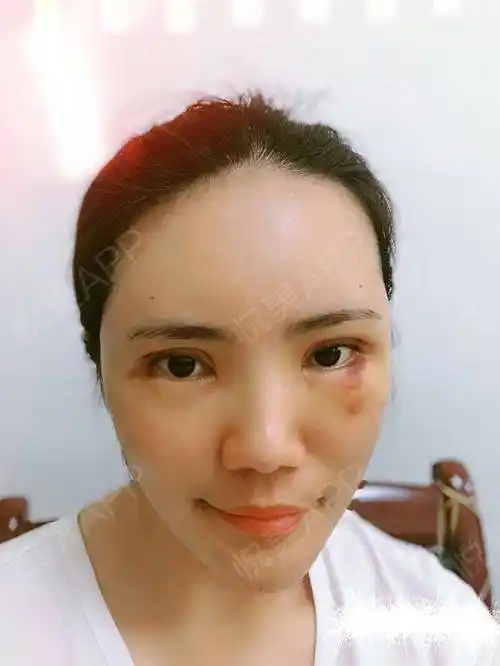 自体脂肪面部填充术后6天_韩式双眼皮术后6天_全切双眼皮术后6天_面部