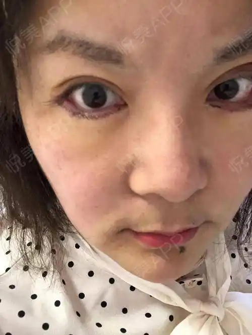 外切去眼袋术后4天_去眼袋术后4天_眼部整形术后4天_喂妖妖灵分享图片