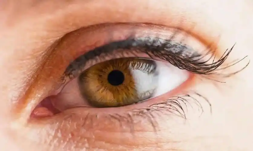 死人眼睛瞳孔全图胆小者慎入世界十大恐怖眼球病例报告让人虚惊一场的