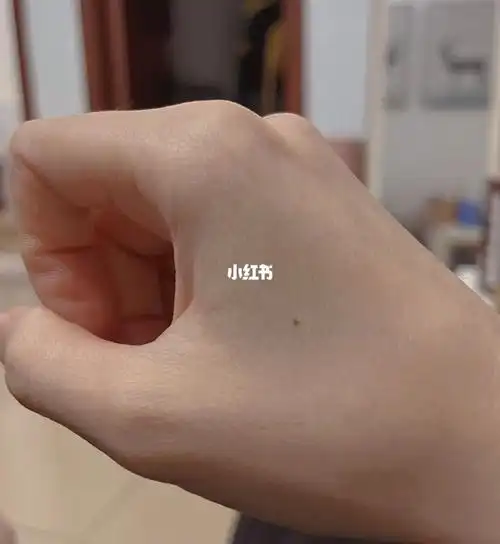 关于右手虎口中间长了一颗痣这件事