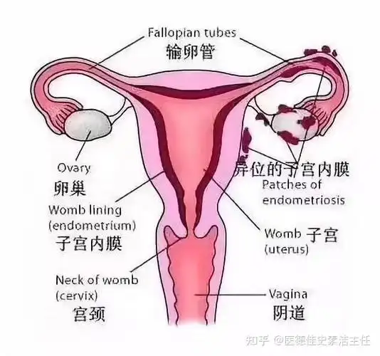 医德佳史素洁主任 的想法: 女性切除了子宫,如果仅仅切除子宫,卵巢