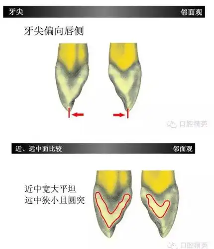 上颌尖牙(上3)如此复杂?学习了