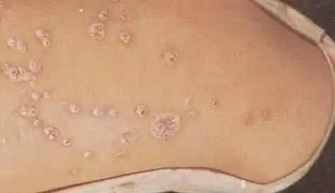 感染了梅毒,身体会出现这3个异常表现,越早发现越好