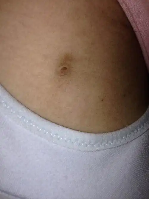 请帮我看看这是不是个小乳头,长在腋下附近,去年开始长的,当时以为是