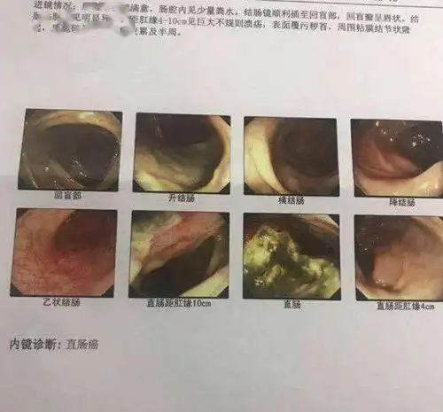 案例剖析丨22岁小伙错把肠癌当痔疮一发现就是晚期医生教你分辨痔疮和