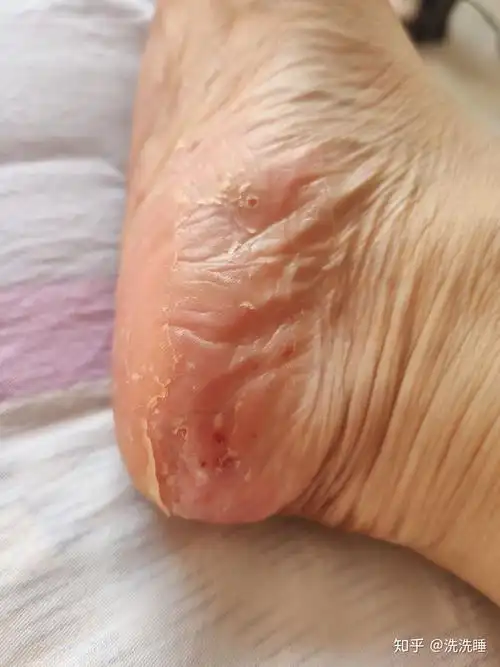 掌跖脓疱病治疗