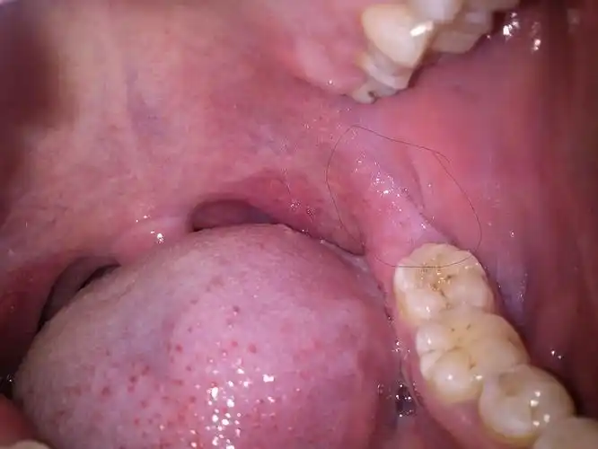 医生,请帮忙看一下我的口腔白斑是不是很