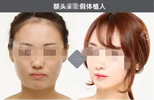 韩国德莱茵假体垫额头实例图