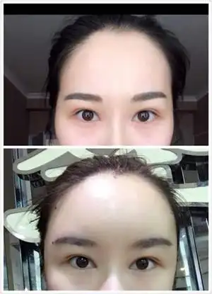 自体脂肪丰太阳穴 丰额头案例以及前后对比照片分享