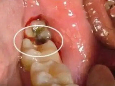 蛀牙不用补也可以自愈?