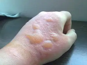 「烫伤经历」手手二度灼伤/烫伤的惨痛教训