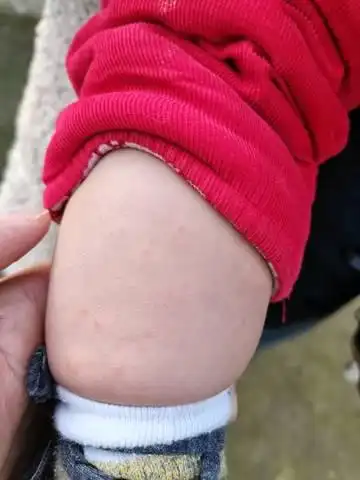 孩子8个月零10天,今天下午小腿开始出现红点,晚上增加到大腿,密密麻麻