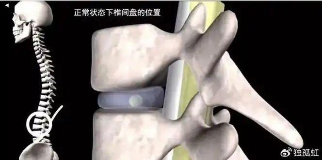 腰椎间盘突出千万不能做这个动作|仰卧起坐|腰椎|腰椎间盘突出_新浪新