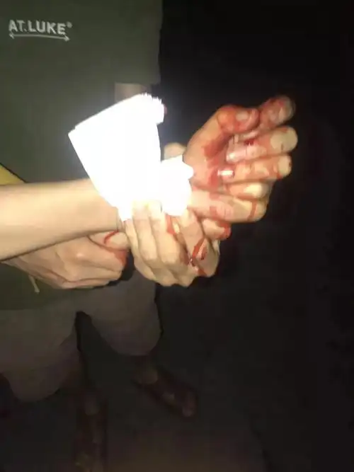 鲜血直流桂林女子被划破大动脉最担心的事还是发生了