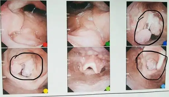 正常的声门结构受新型冠状病毒疫情影响,小彭一直拖着没来医院,近段