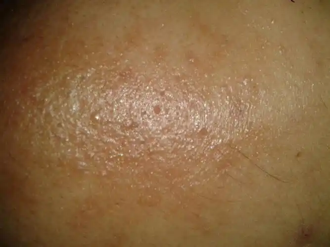 男,23岁,脸部皮肤这样十几年了,一直没好,照片放大后能看见密密麻麻的