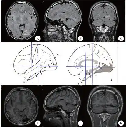 a(轴位),b(矢状位),c(冠状位):术前mri,显示围距状裂异常信号,考虑为