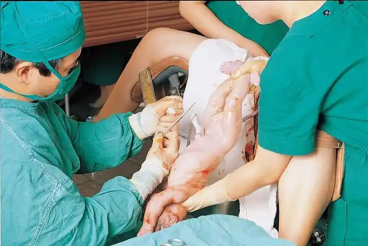 胆小勿看,实拍孕妇顺产惊心全过程,为全天下的妈妈点赞_孩子