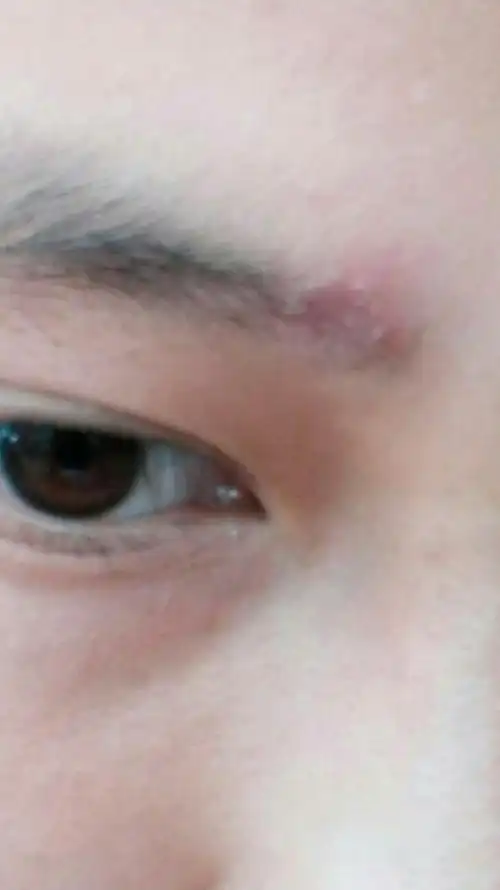 我这眉毛里的那个圈圈是什么?都有一个月了