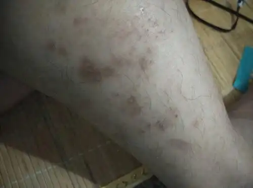 抓的出血结壳了又抓的出血反反复复的就留下了黑印子请问这是什么病什