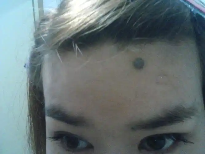 我额头一个痣出生时就有,人长它也长,现在已定型了,痣长的中等大,我想