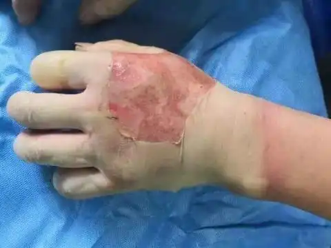 梦见手被火烧伤