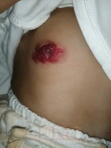 孩子乳房上的是什么类型的血管瘤?好治吗?