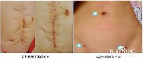 怎么宫外孕治疗?