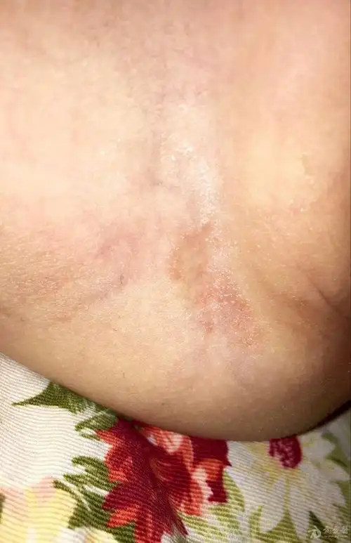 腹股沟皮损