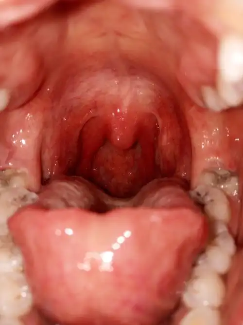 早上被喉咙痛的醒来,昨晚还好好的,也没感冒,喉咙痛的睡不着,以为