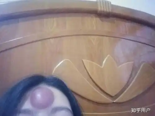 额头可以拔罐吗?